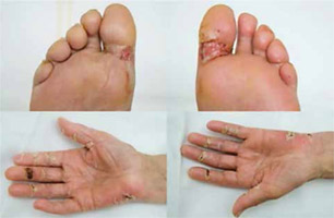 PPE (Palmar-Plantar erythrodysestesie) po chemoterapii